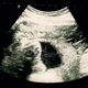 Ultrasonidos de un embarazo abdominal. Wikimedia Commons